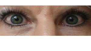 Manhattan BLEPHAROPLASTY after 4